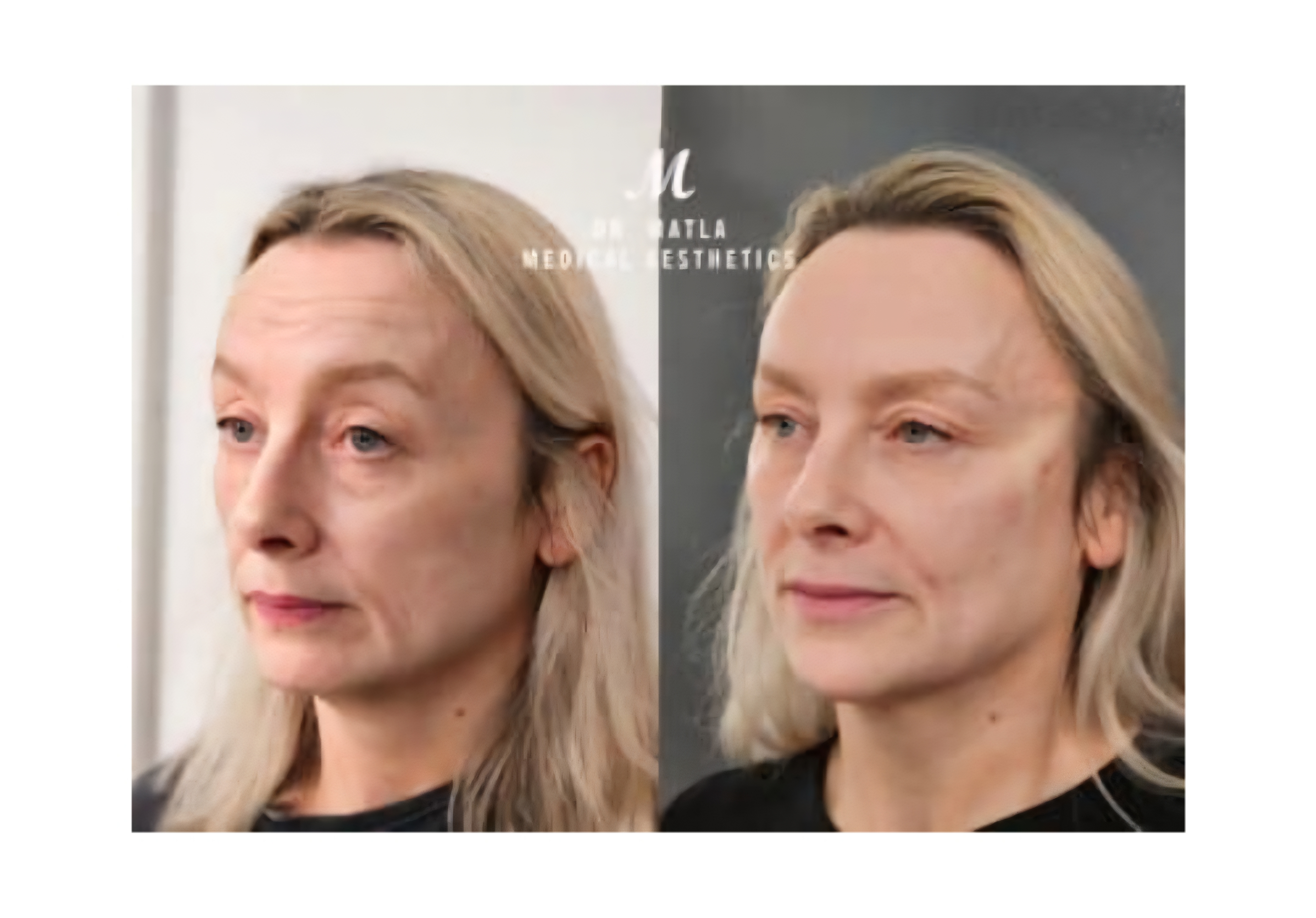 Treatment result